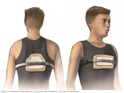 Colete PEITO DE POMBO  Para Tratamento do pectus carinatum e excavatum